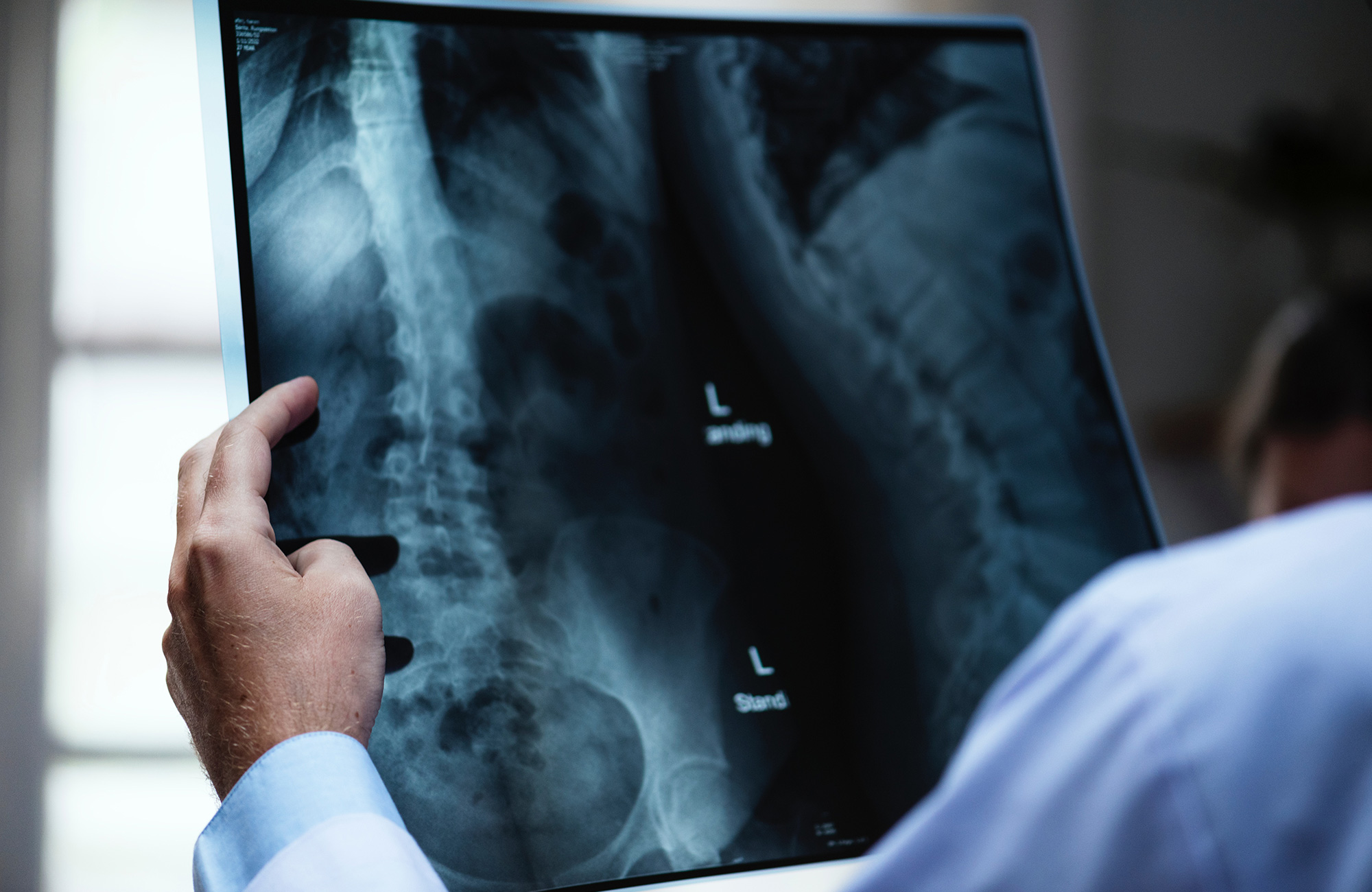 en læge kigger på et røntgenbillede